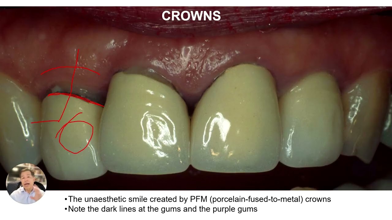 Understanding Dental Crowns  Enhancing Your Smile! 🦷