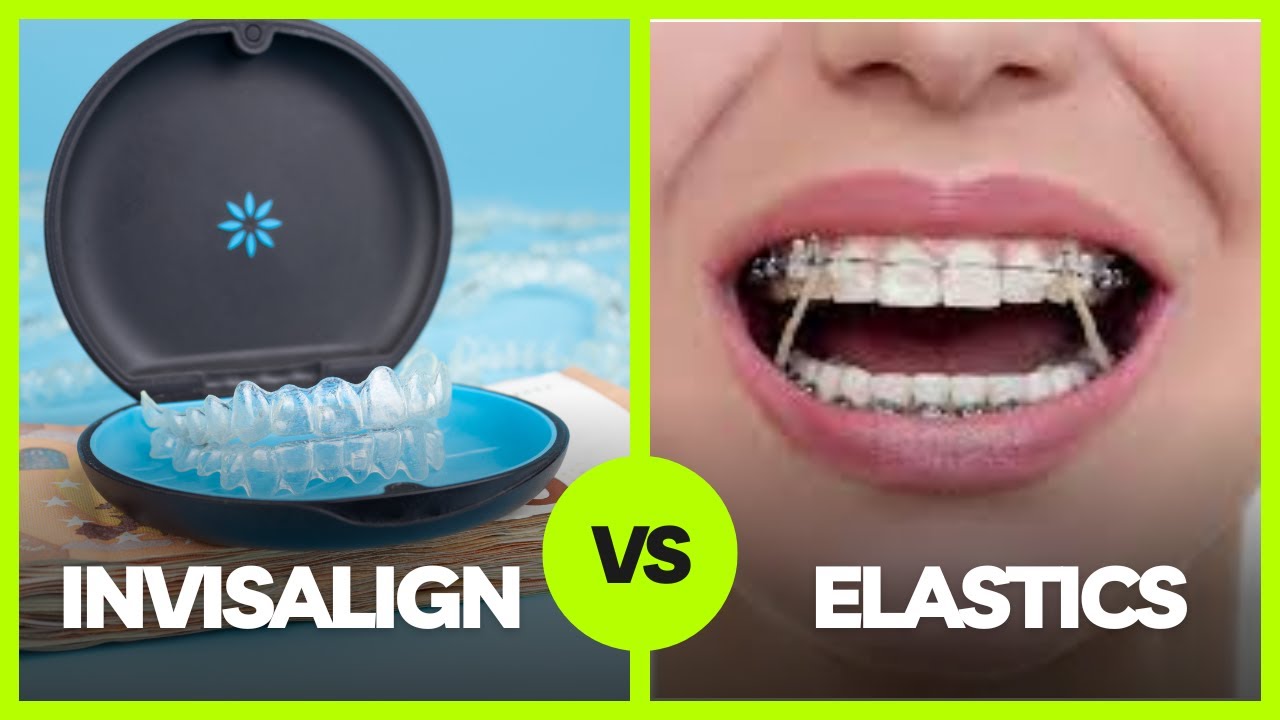 Invisalign and Elastics and TRACKING- What NOT to do!