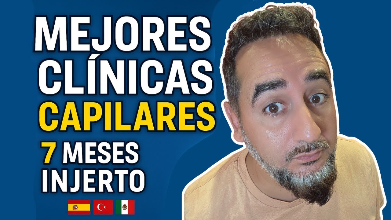 INJERTO CAPILAR resultado 7 MESES y MEJORES CLÍNICAS en España, Turquía, México