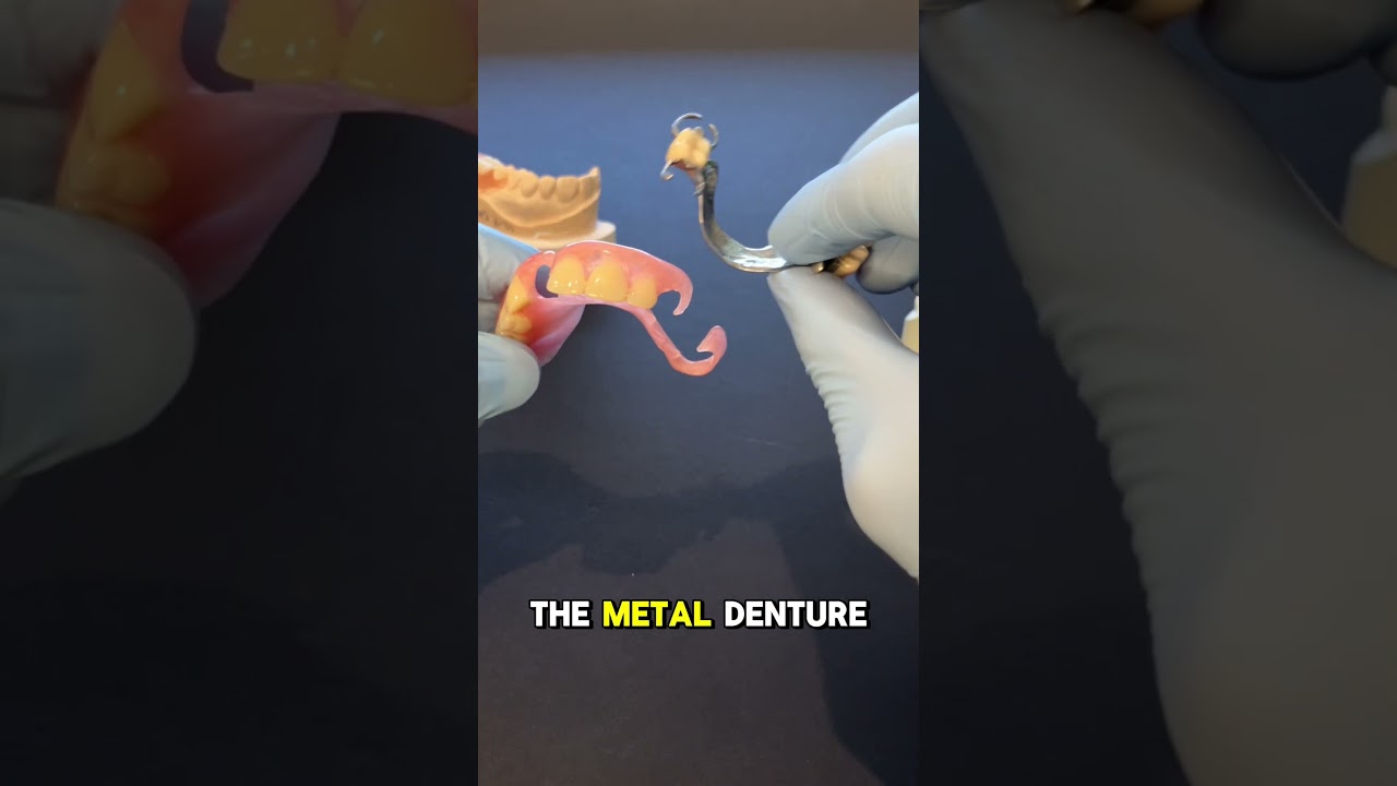 Removable partial dentures are an alternative to dental implants! #dentist