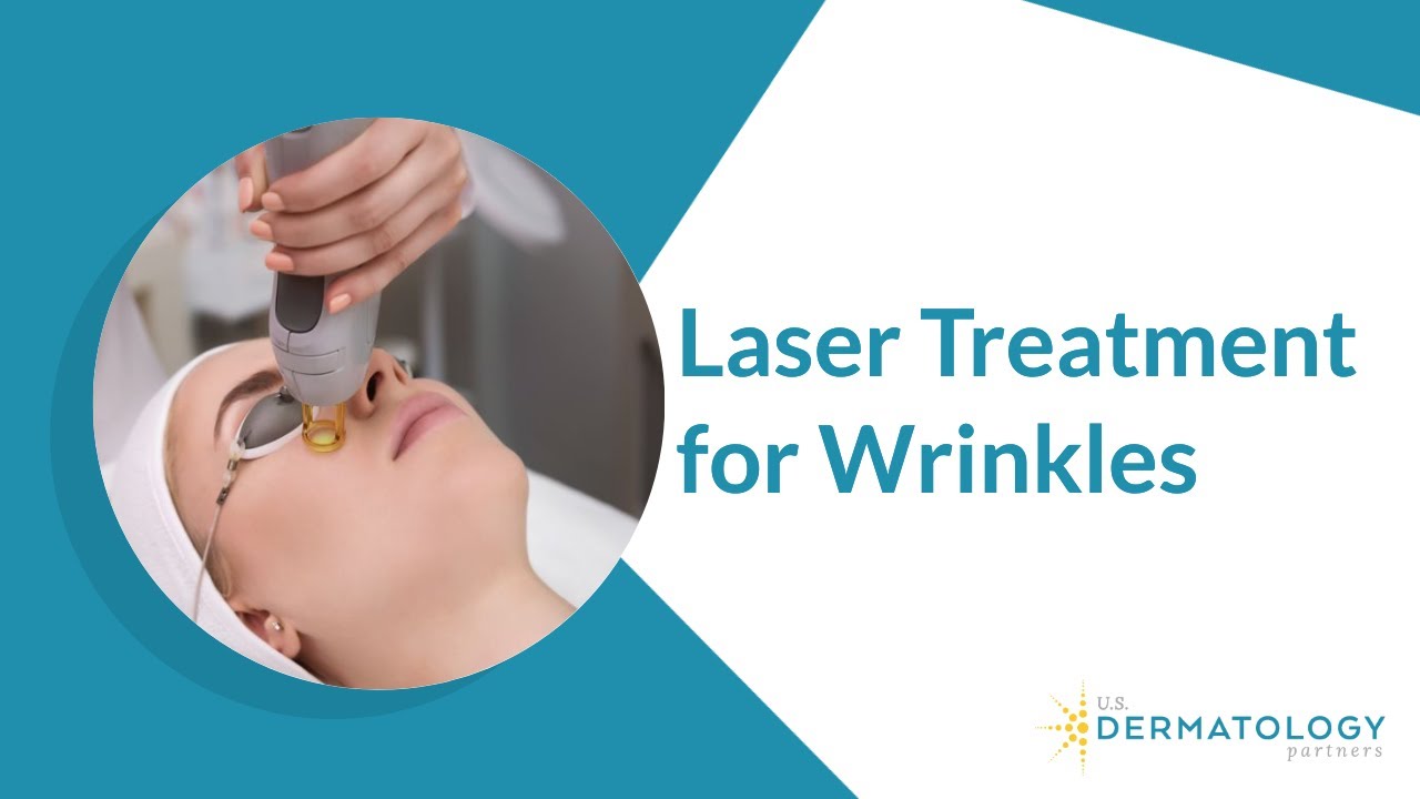 Laser Treatment for Wrinkles Removal