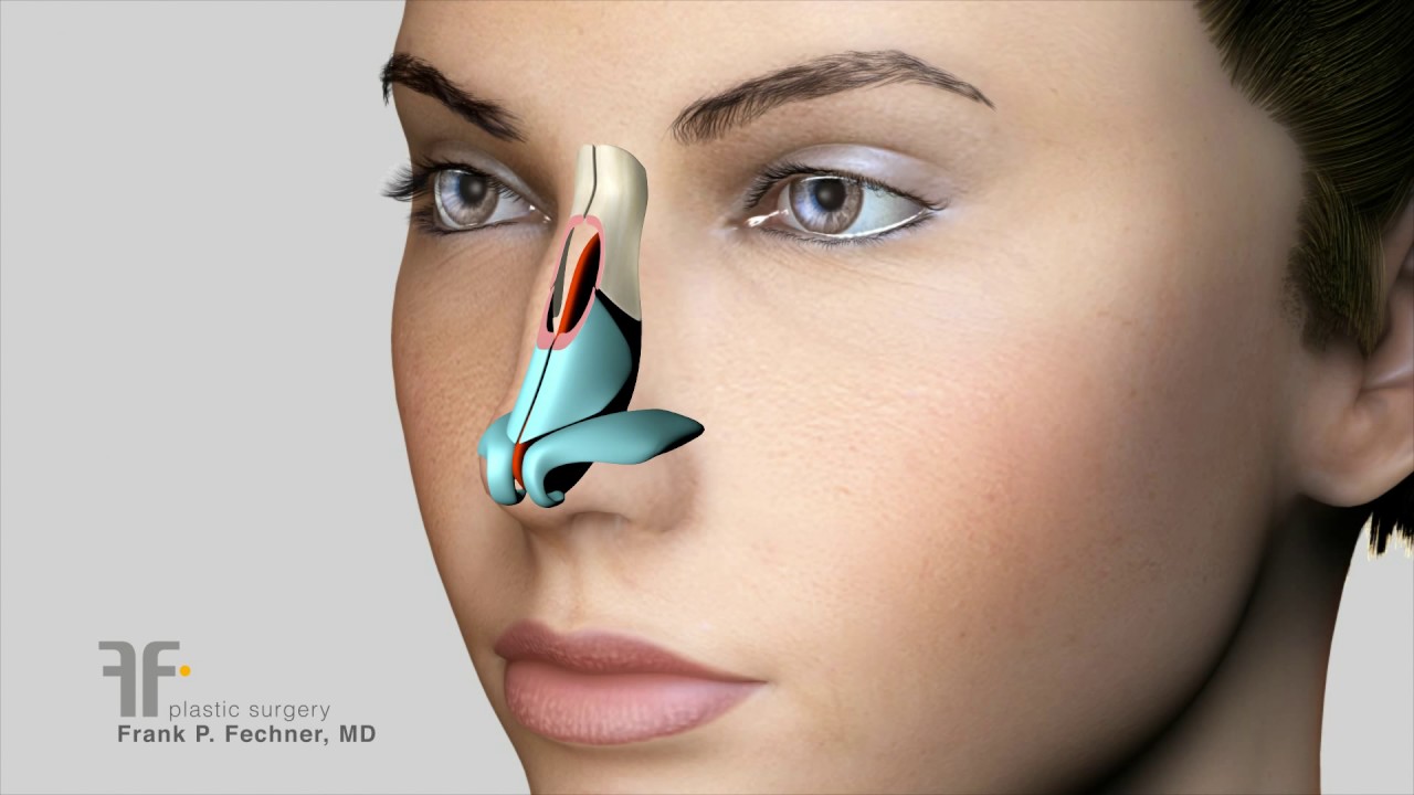 How to Remove Bumps on Nose Large Nose Surgery by Dr. Fechner - RHINOPLASTY ANIMATION