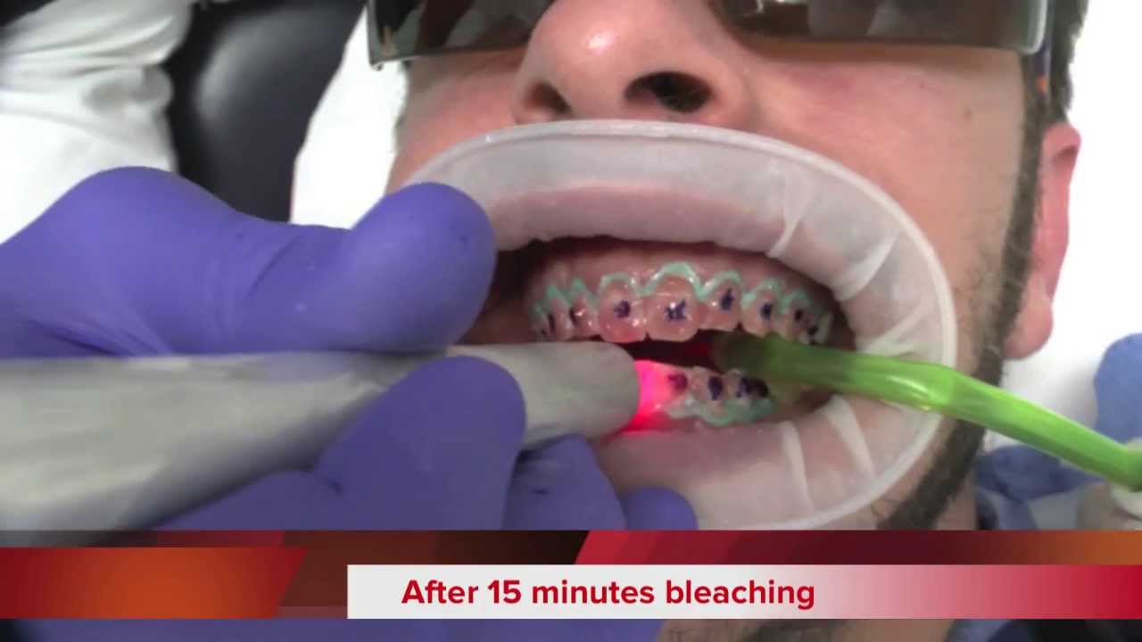 Sbiancamento  dentale  con Laser