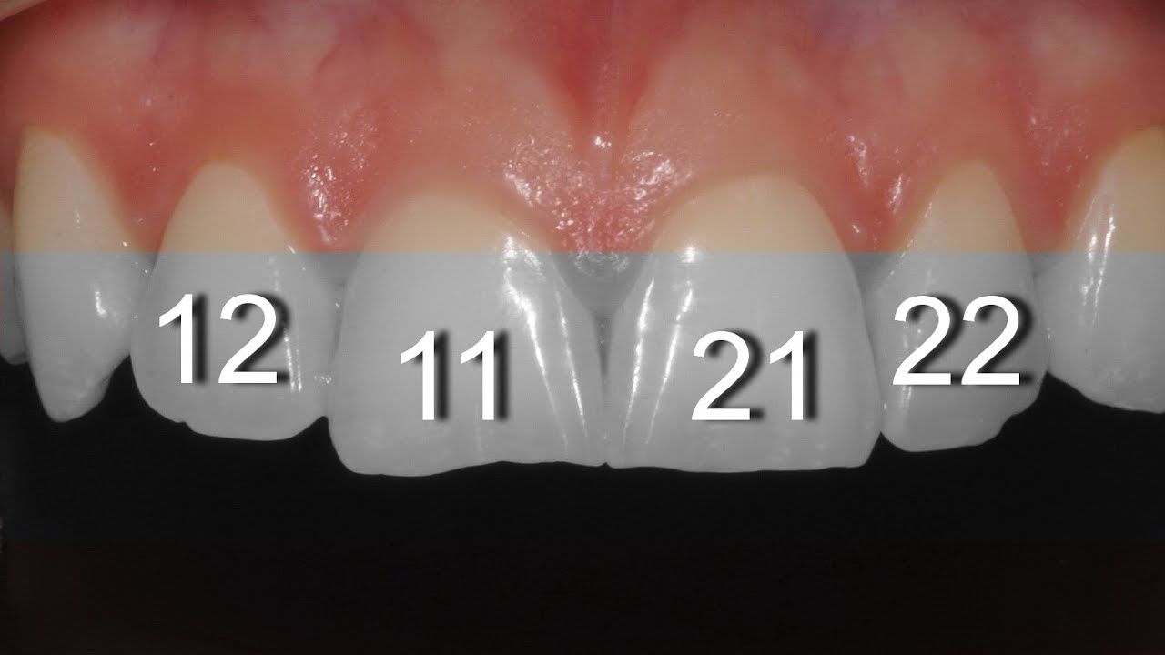 Прямая и полупрямая реставрация передних зубов композитом. iGos и Esthet-X. Front teeth restoration.