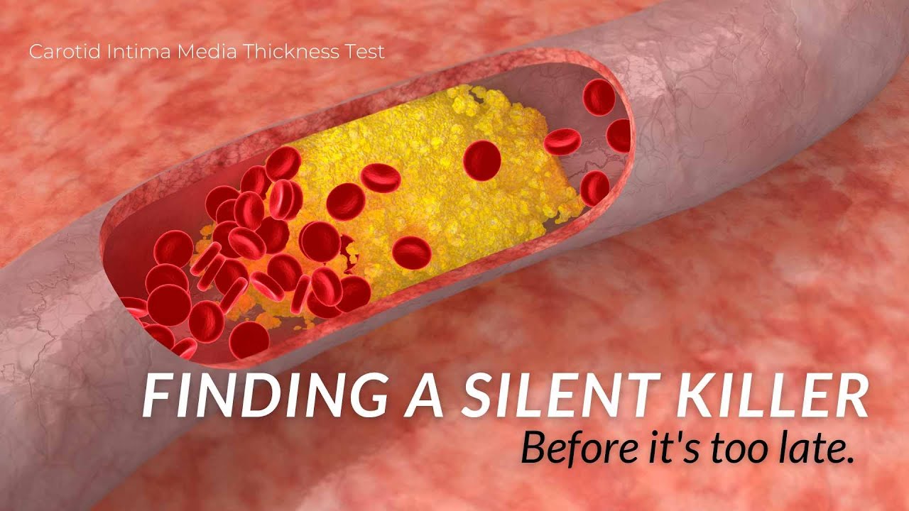 Exposing a Hidden Killer - CIMT to Prevent Cardiac Events