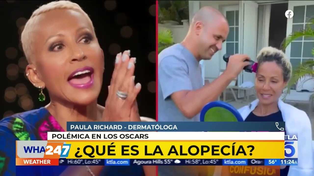 &iquest;QUE ES LA ALOPECIA?  PAULA RICHARD