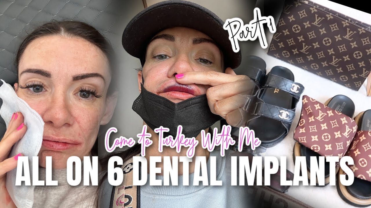 COME TO TURKEY WITH ME TO GET MY TEETH DONE // All On 6 Dental Implant Journey (Part 1)