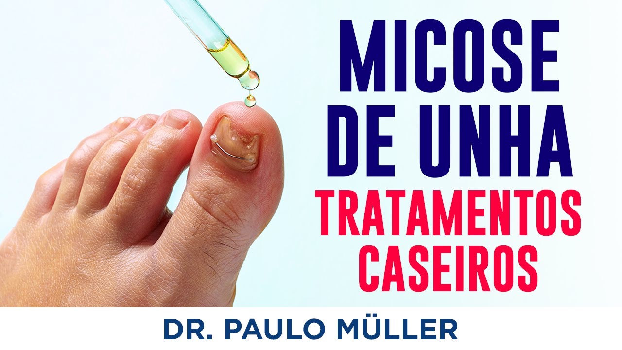 3 Tratamentos Caseiros para Micose de Unha – Dr. Paulo Müller Dermatologista.