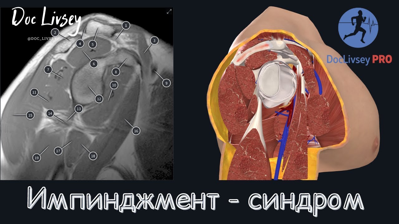 Импинджмент синдром