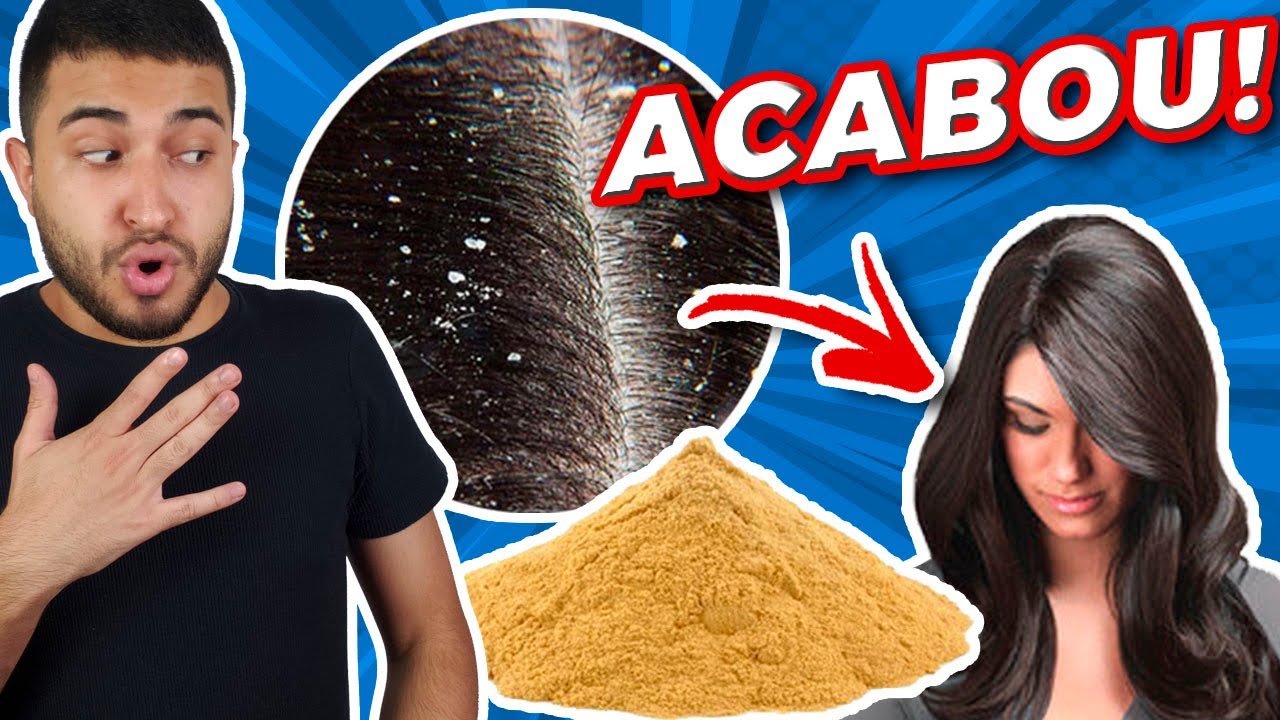 Como ACABAR com a CASPA! Forma MATADORA de como tirar caspa do cabelo! [COMPROVADO]