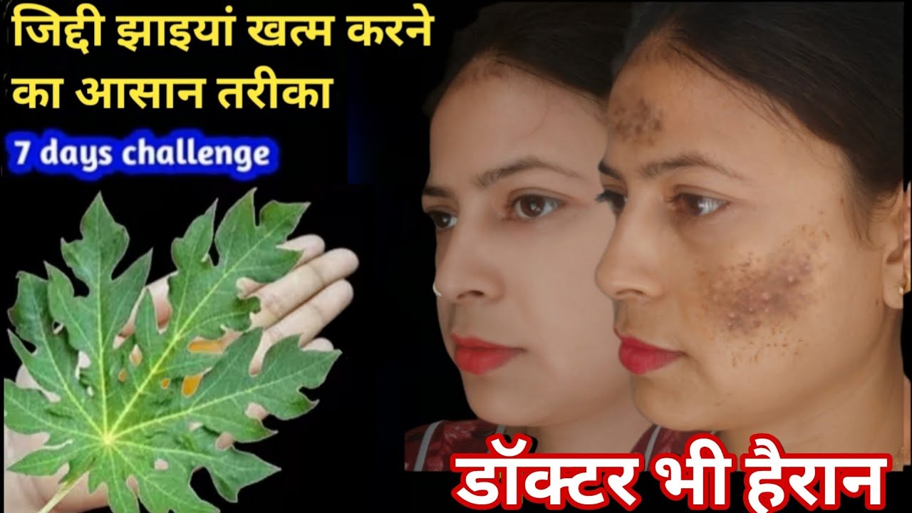 ❣️चाची की 10 साल पुरानी झाइयां सिर्फ 2 दिन में गुड़ से गई,वो गोरी भी हुई 😍
