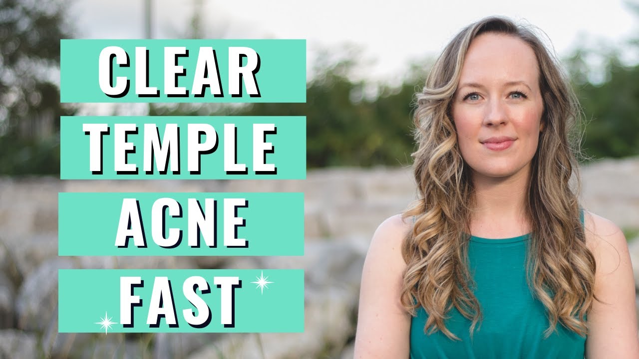 Acne on temples - CLEAR TEMPLE ACNE FAST