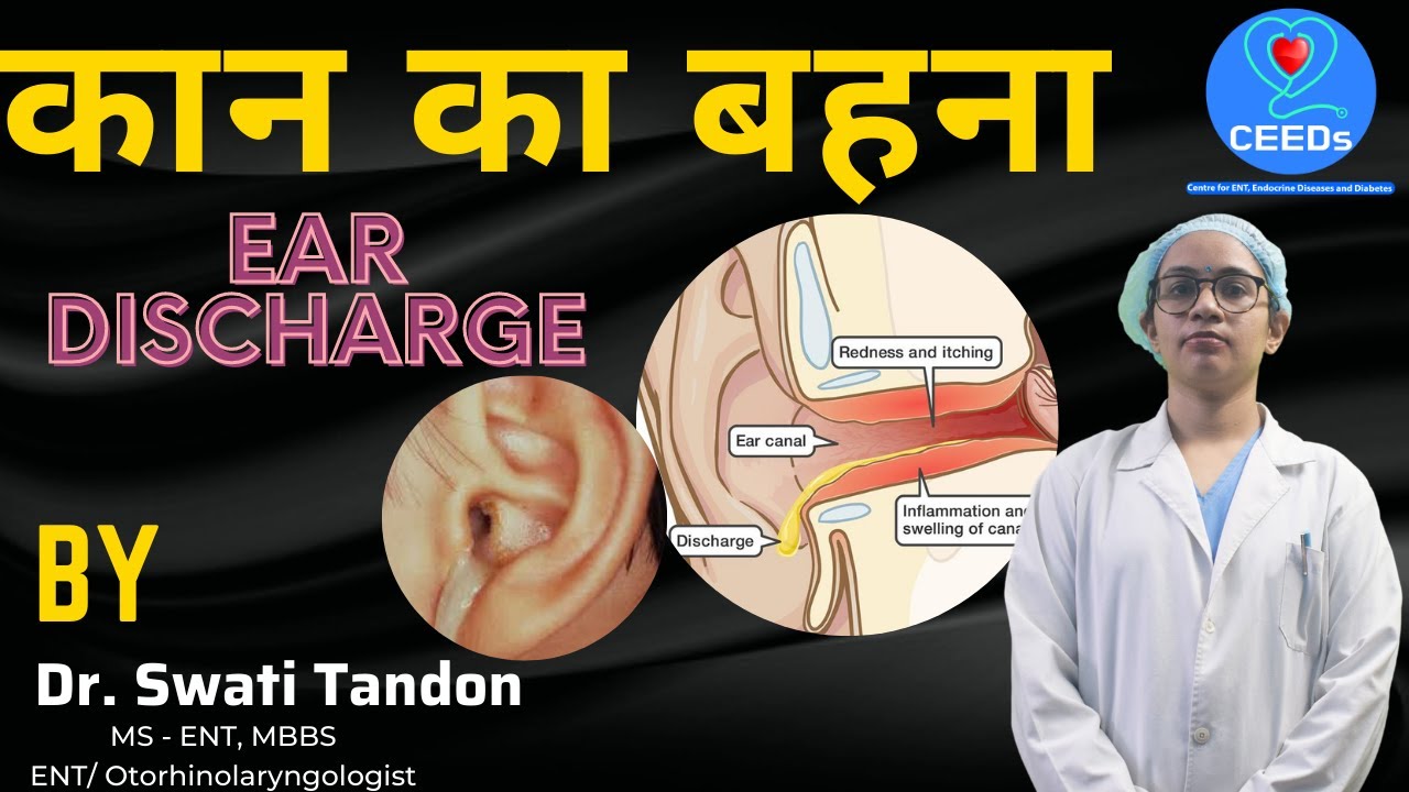 कान बहने का कारण और इलाज़ | How to stop #EarDischarge |Dr. Swati Tandon, Ent Specialist in Delhi