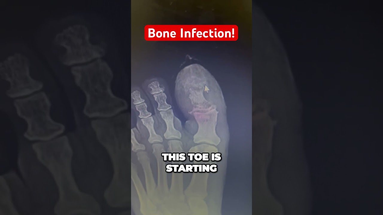 تطور عدوى العظام #التهاب العظم والنقي #طب الأقدام