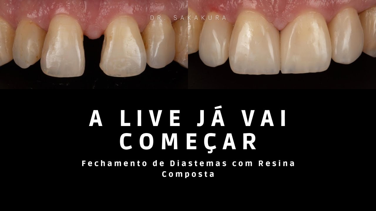 Hands on - Fechamento de Diastemas com Resina Composta