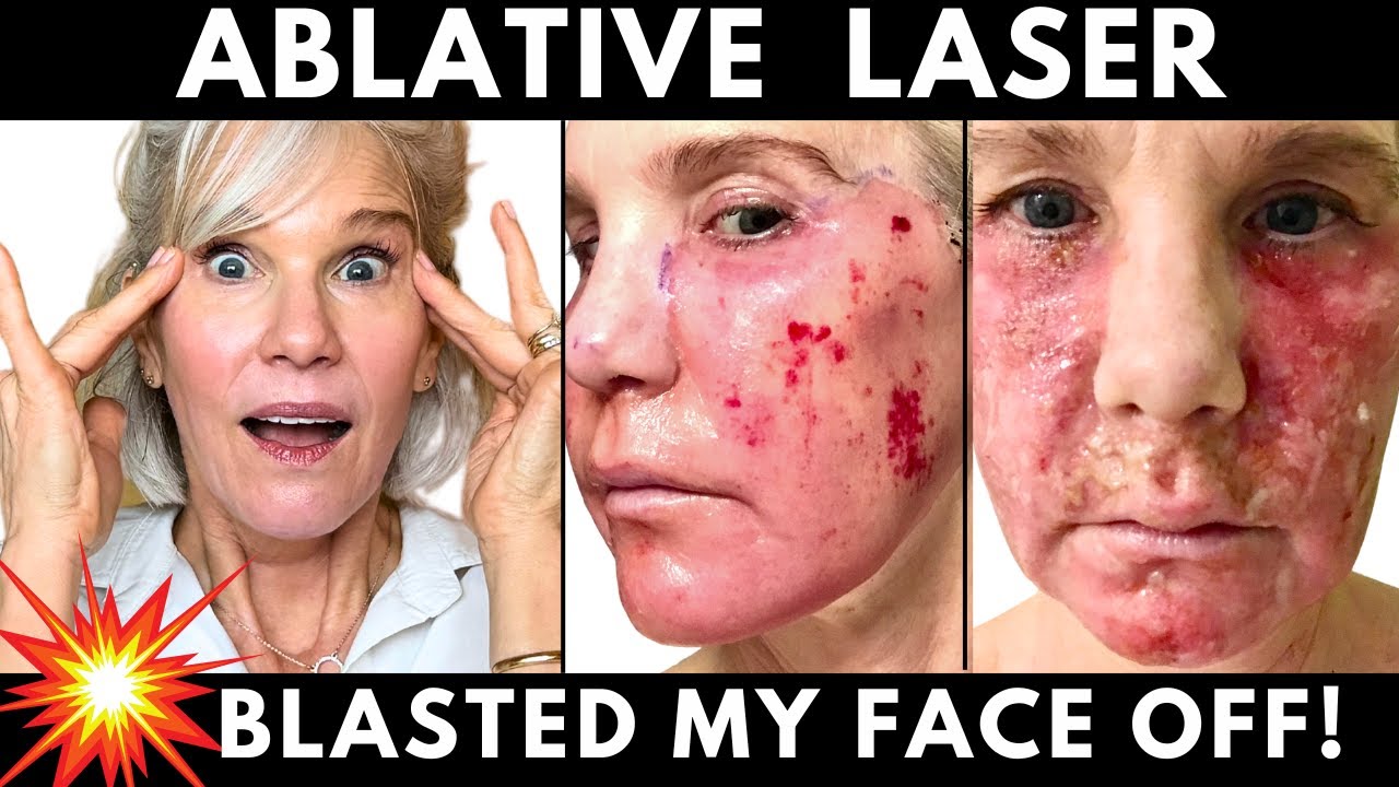 One and Done Anti-aging Treatment at 54! (Down Time and Recovery)