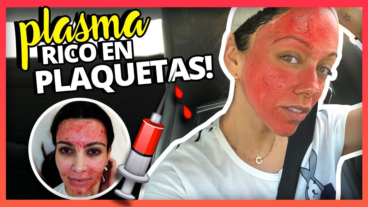 PLASMA RICO EN PLAQUETAS: ME INYECTE MI PROPIA SANGRE EN LA CARA???