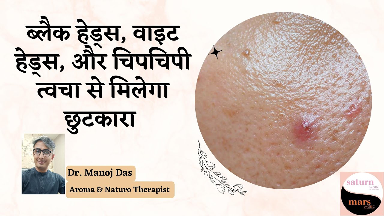 ब्लैक हेड्स, वाइट हेड्स, और चिपचिपी त्वचा से मिलेगा छुटकारा I OILY SKIN CARE TIPS I DR. MANOJ DAS
