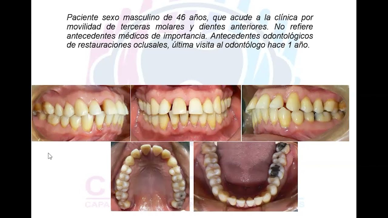 CLASIFICACIÓN DE PERIODONTITIS