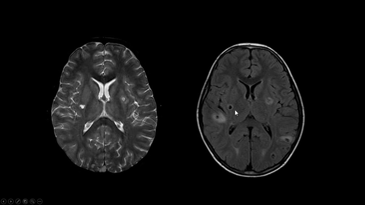 Neurocisticercose