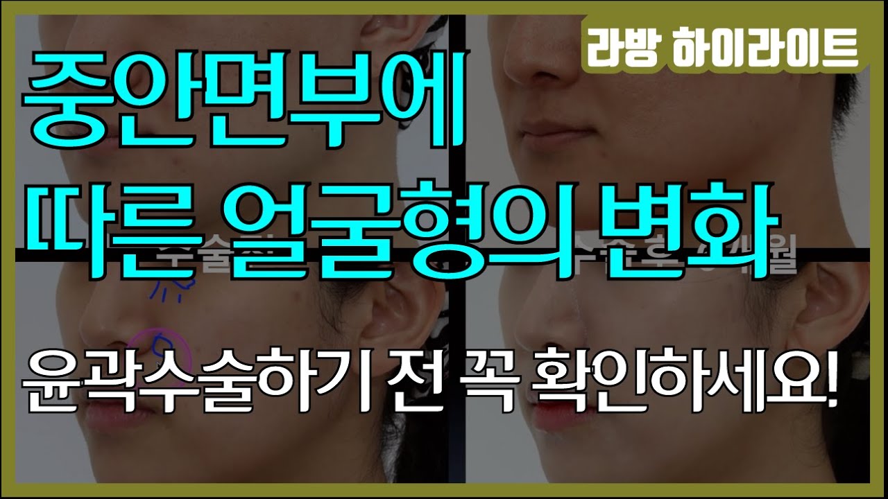 [SUB] 중안면부에 따른 얼굴형의 변화 / 수술하기 전 꼭 중안면부를 이해하시길 바랍니다. (JPN) 中顔面部による顔の形の変化 / 手術する前必ず中顔面部を理解してください