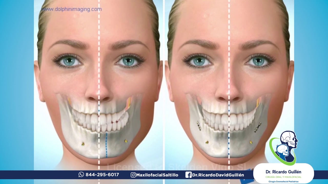Corrección de Asimetría Facial - Laterognasia