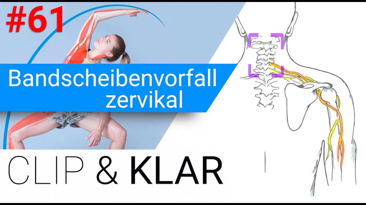 zervikaler Bandscheibenvorfall erkl&auml;rt - Schmerzausstrahlung in den Arm