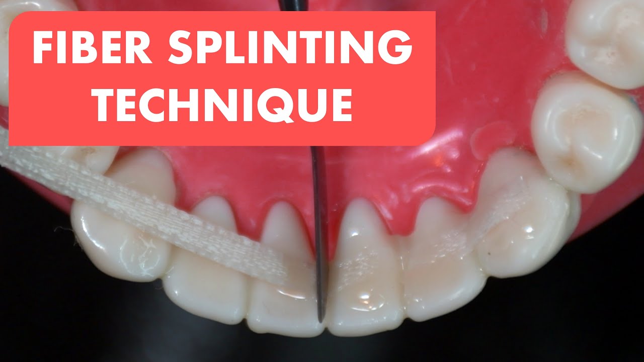 FIBER SPLINTING | Easiest splinting technique
