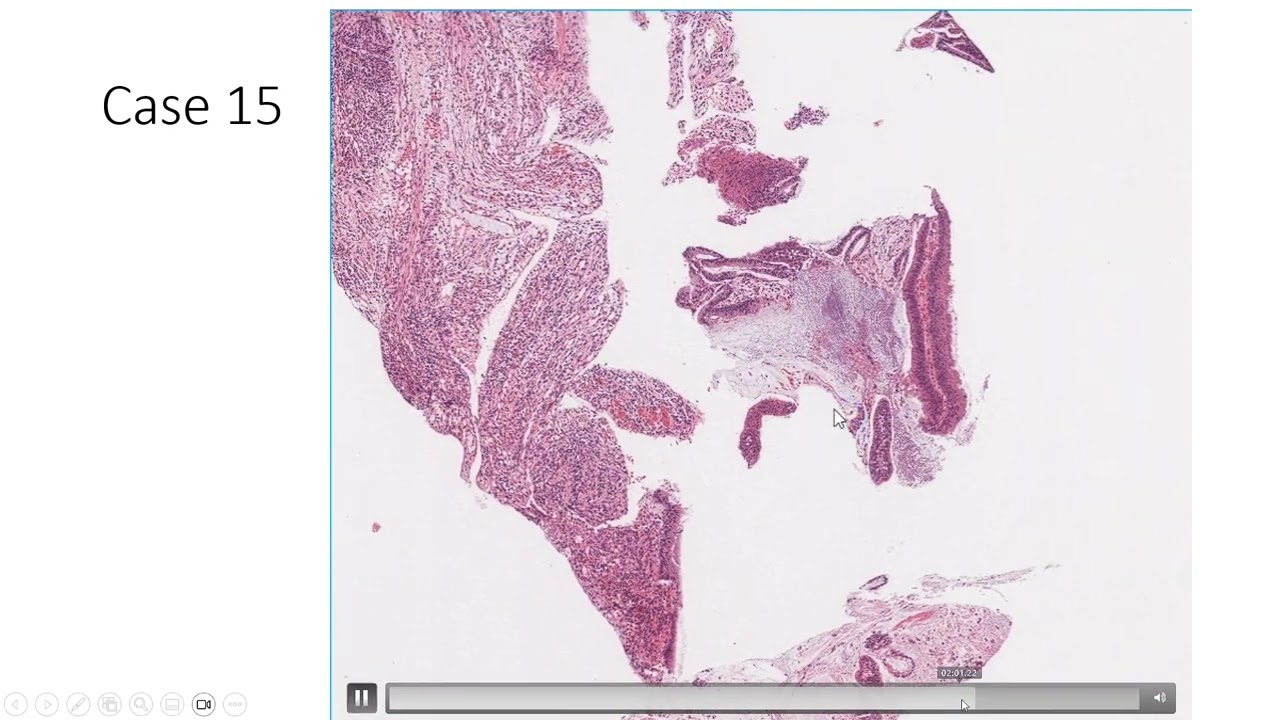 Case (SI 15): Mucinous Adenocarcinoma