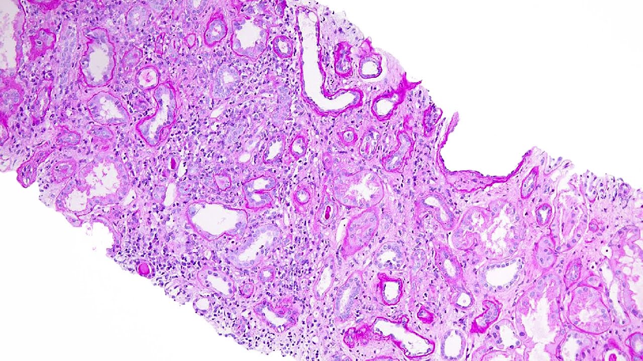 Polyomavirus Nephritis | Banff & Beyond