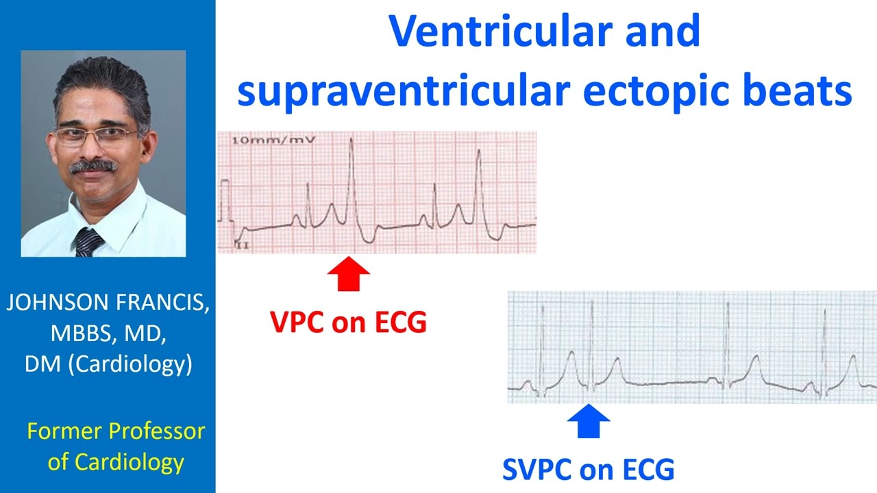 Ventricular and supraventricular ectopic beats