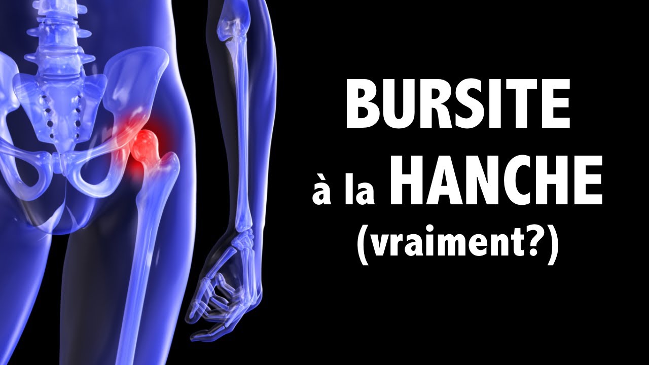 Bursite à la hanche: si la douleur provenait plutôt des muscles fessiers
