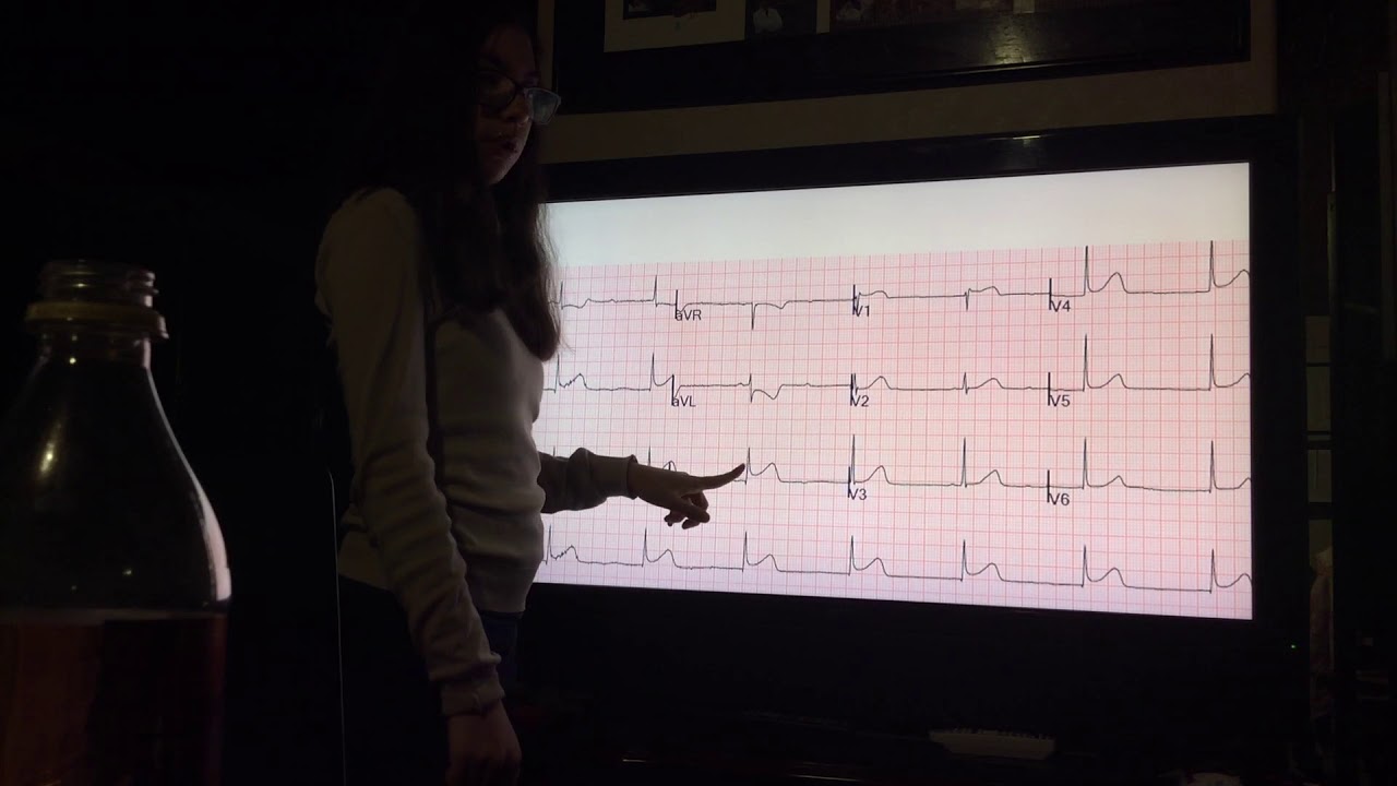 STEMI Descendente Posterior. Infarto.