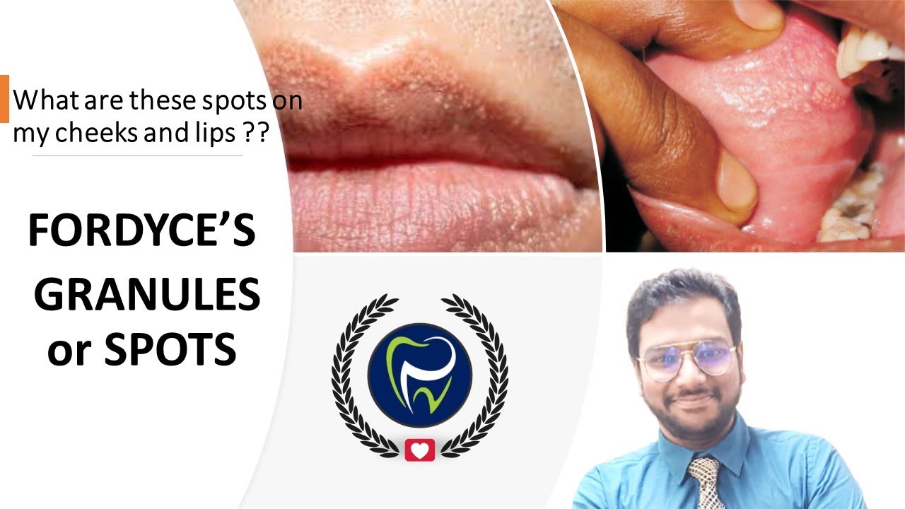 Dr Rudra Mohan | Fordcye's Granules/Spots| What are these granules/spots on my cheek???