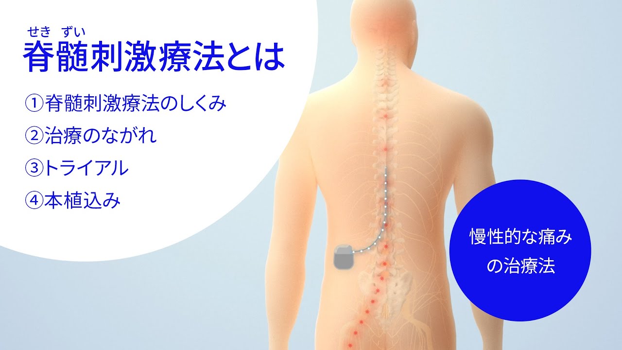 脊髄刺激療法とは？ 治療の流れと具体的な方法