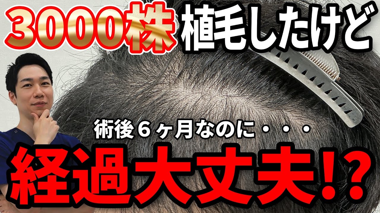 3000株の植毛手術で「思っていたほどの変化がない？」｜術後6ヶ月の患者様の経過を丁寧に解説