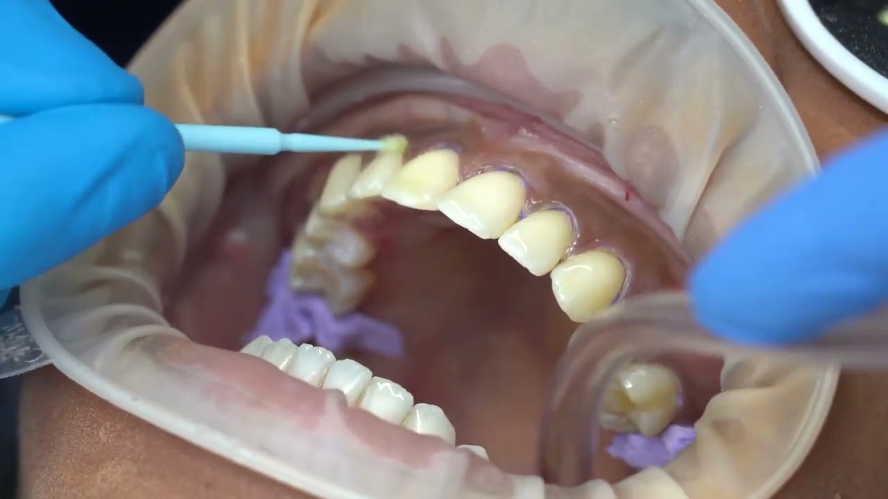 SmileFast Process