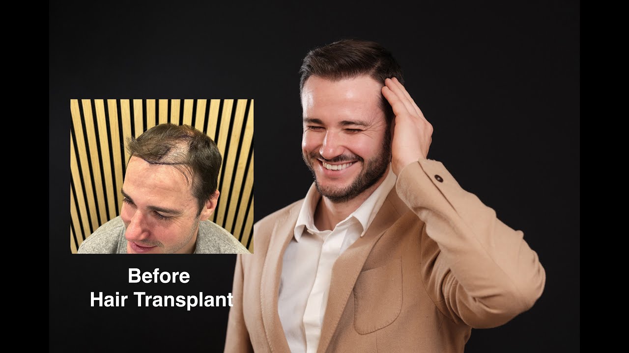 Rob Share His Hair Transplant Experience By Dr Mark Tam, Frontal Area