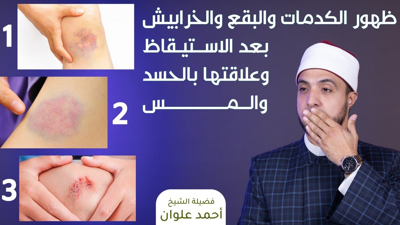 علاقة الكدمات والبقع الزرقاء والخرابيش على الجسم بالسحر والحسد وكيفية العلاج | أحمد علوان