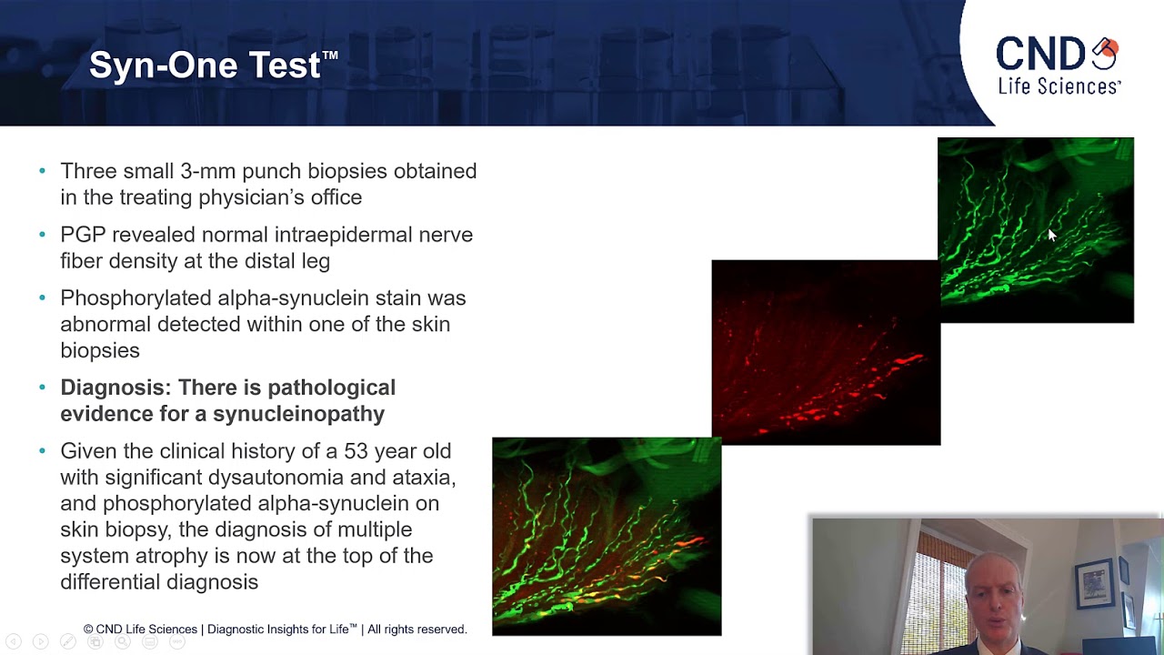 The Patient with Suspected Multiple System Atrophy