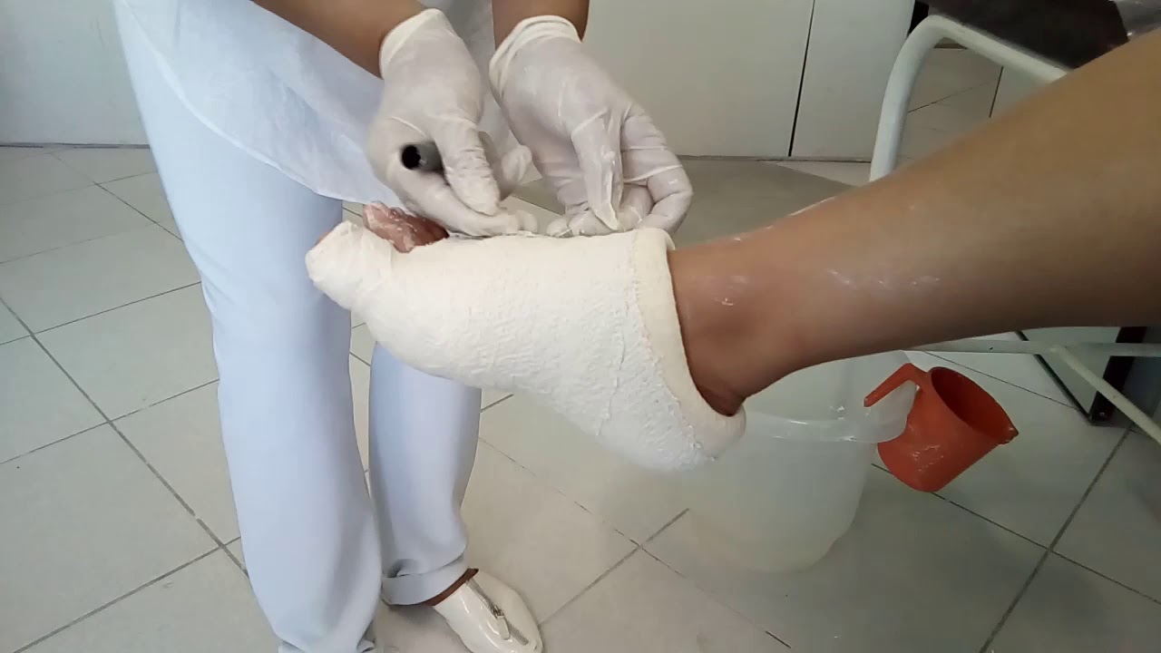 Sapato gessado para  fratura  de halux