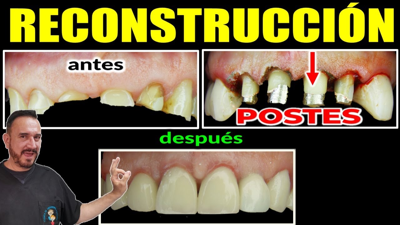 REALMENTE Necesitas Endoposte? Evita la FRACTURA de Tu Muela!