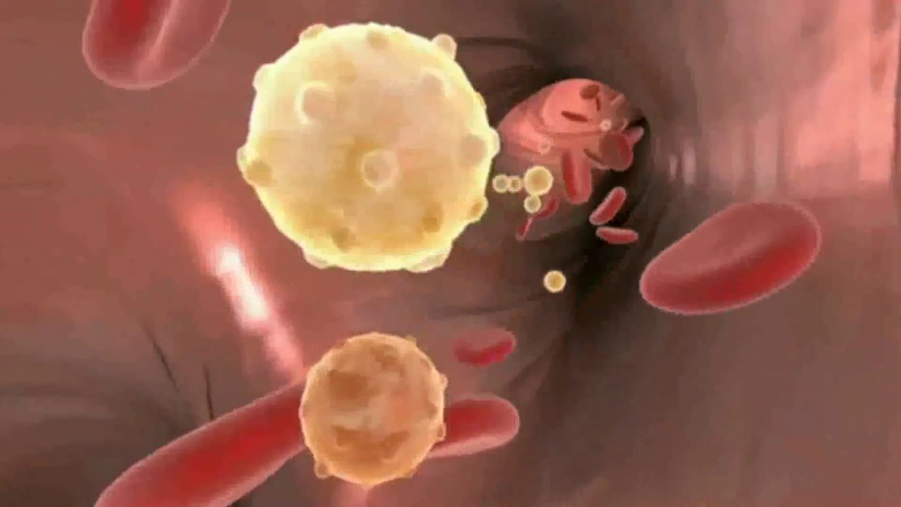 LA ATEROSCLEROSIS