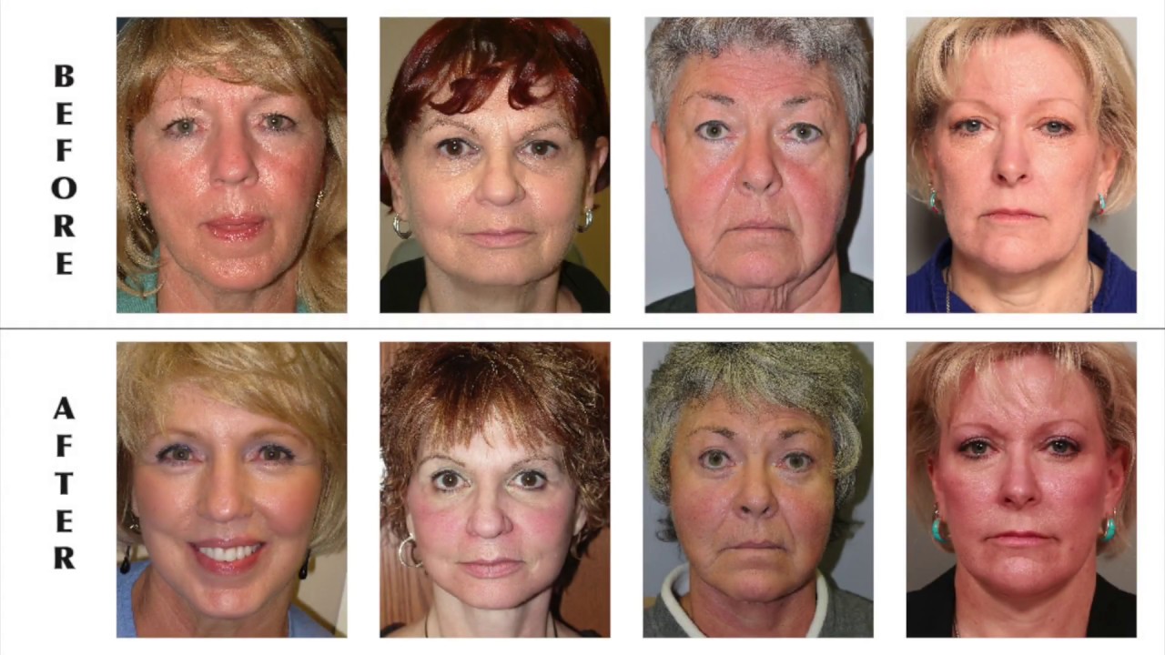 Facelift questions answered by Dr. Fante