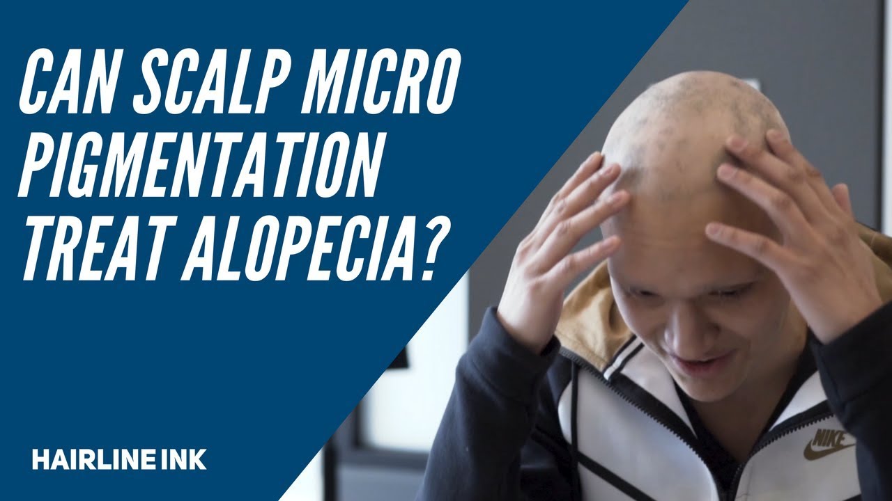 Can Scalp Micropigmentation Treat Alopecia?