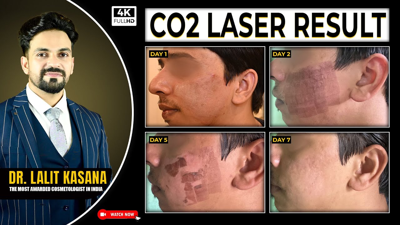 CO2 Laser Result II  CO2 Laser Treatment for Acne Scars |  Before After Results |