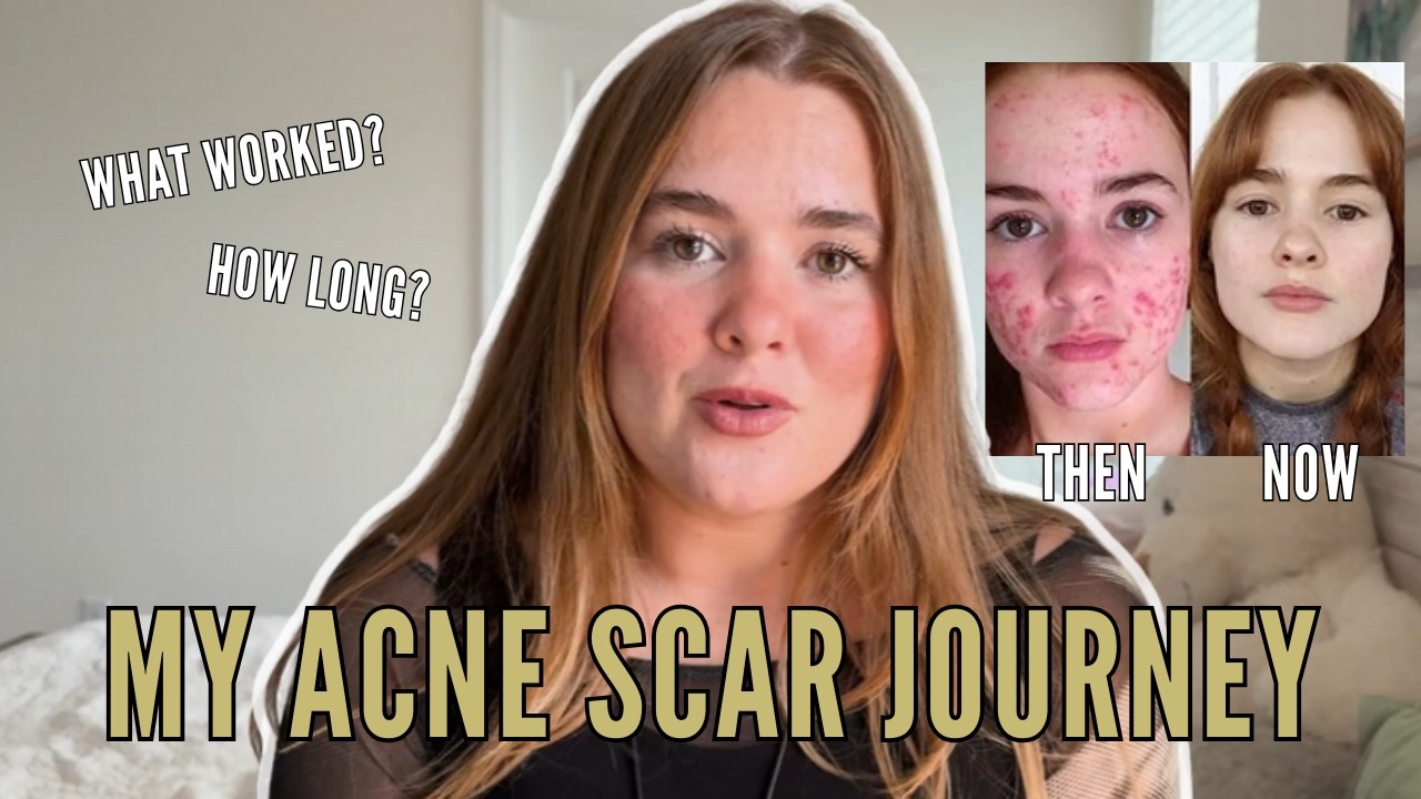 How I Finally Healed My Acne Scars (TOP TIPS)