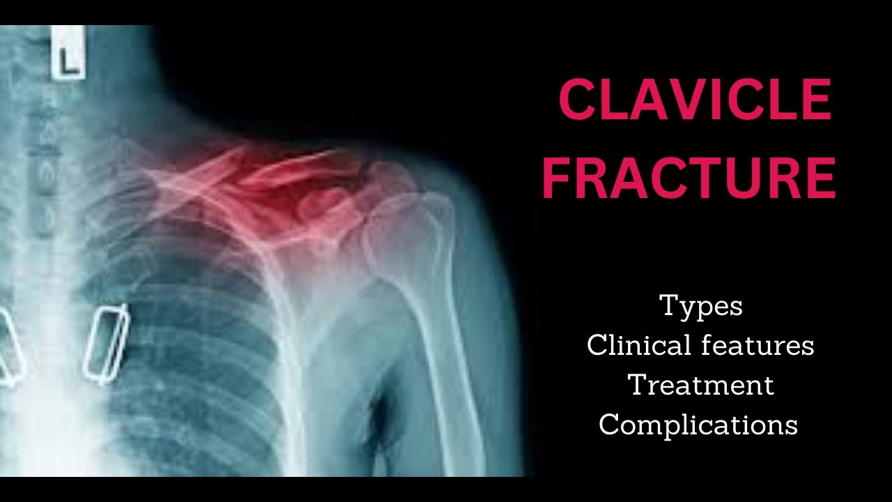 Clavicle Fracture | Collar Bone Fracture | Clavicle Fracture Treatment | #clavicle fracture