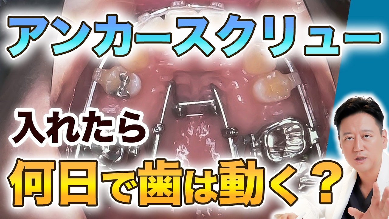 【歯列矯正】アンカースクリューの効果と期間を徹底解説！何日で動き始める？【審美歯科 歯科矯正 歯並び】