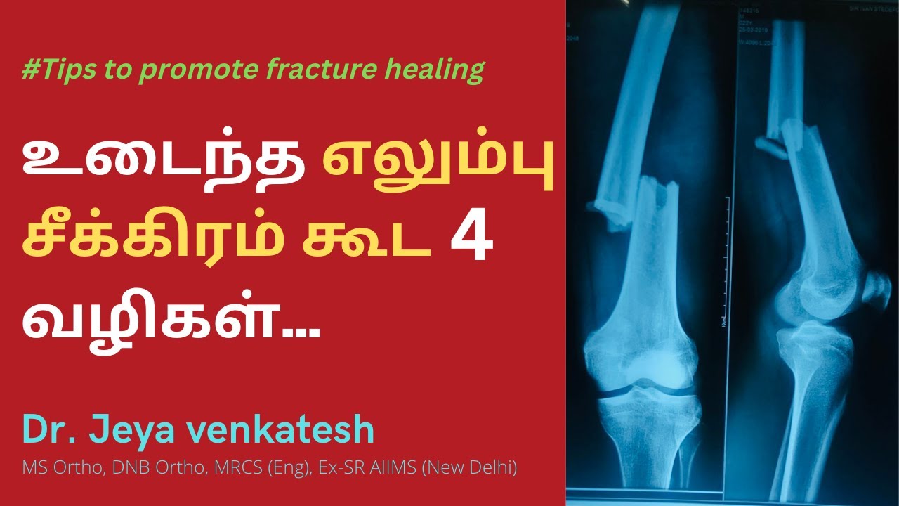 கை அல்லது காலில் உடைந்த எலும்பு சரியாக சீக்கிரமாக கூட என்ன செய்ய வேண்டும் ? #fracturerecovery -DrJV
